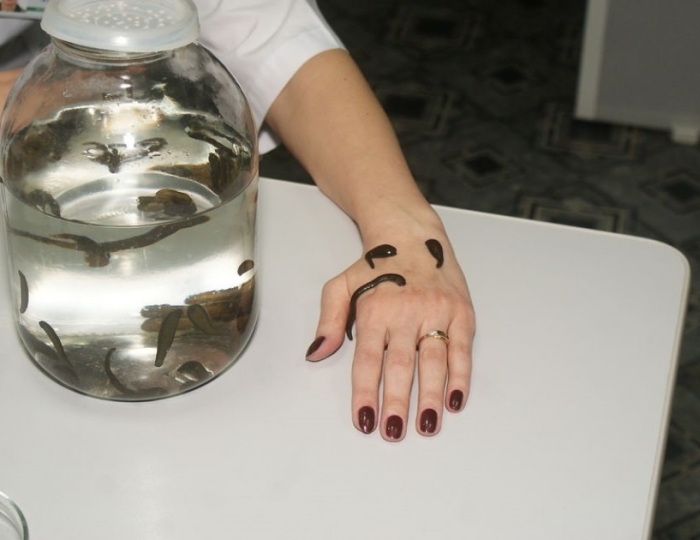 Гирудотерапия - Санаторий «Белая Русь» Беларусь